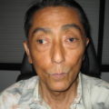 David Before strabismus Surgery