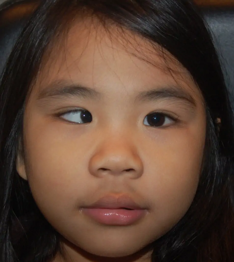 Hyacinth before surgery