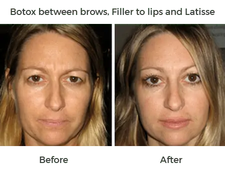 before and after botox, filler to lips and latisse
