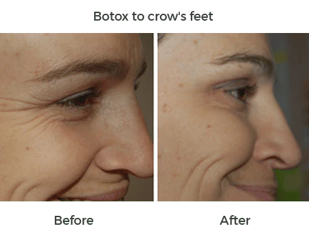 botox to crows feet