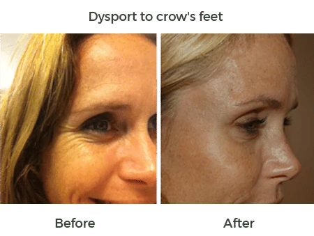 Dysport to crows feet