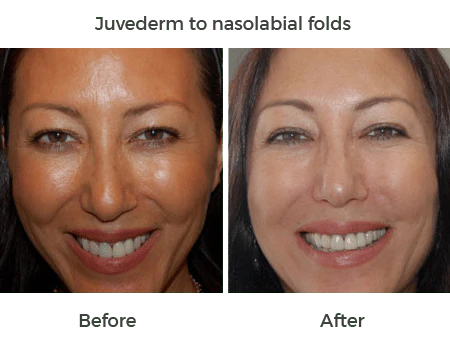 Juvederm to nasolabial