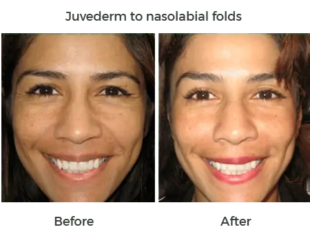 Juvederm to nasolabial