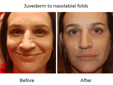 Juvederm to nasolabial