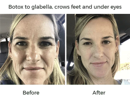 botox to glabella, crows feet and under eyes