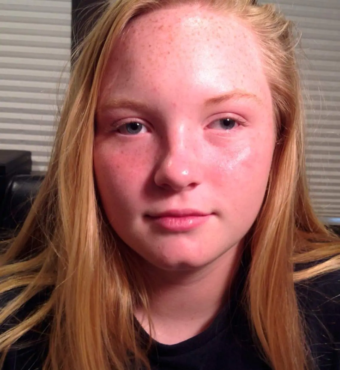 Emma Before Surgery