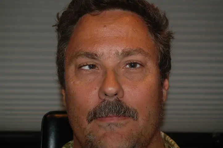Forest before strabismus surgery