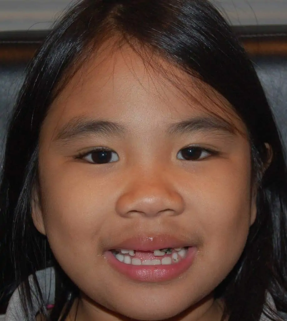 Hyacinth After Surgery