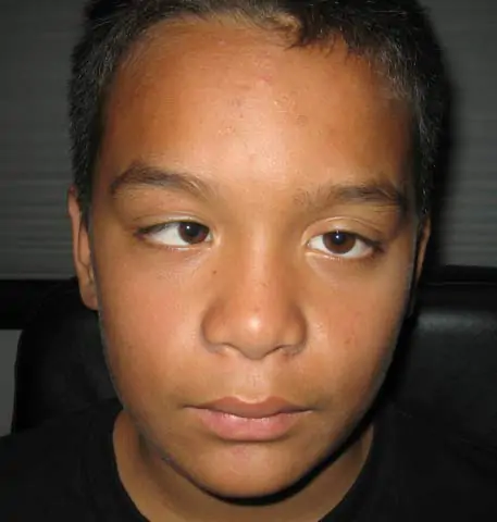 Kailu Before surgery