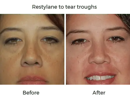 restylane to tear troughs