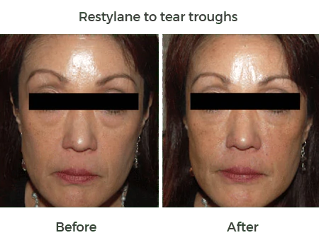 restylane to tear troughs